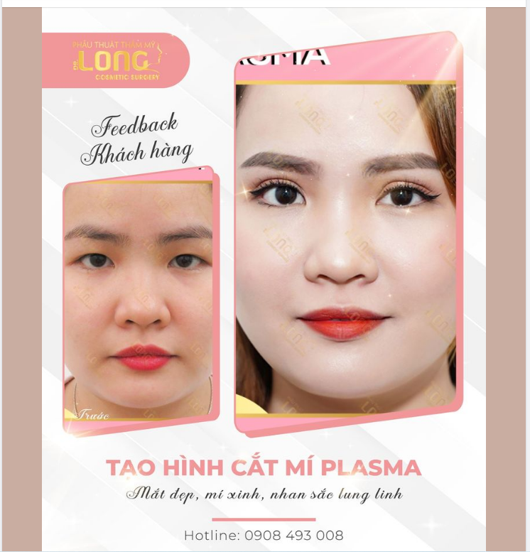 30 phút cắt mí bạn sẽ thay đổi như thế nào