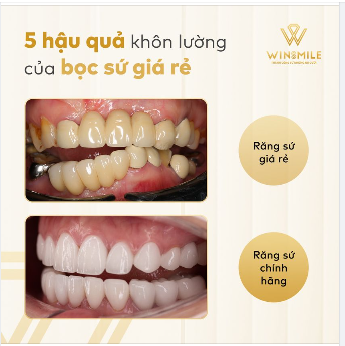 5 HẬU QUẢ KHÔN LƯỜNG KHI THẨM MỸ RĂNG SỨ GIÁ RẺ