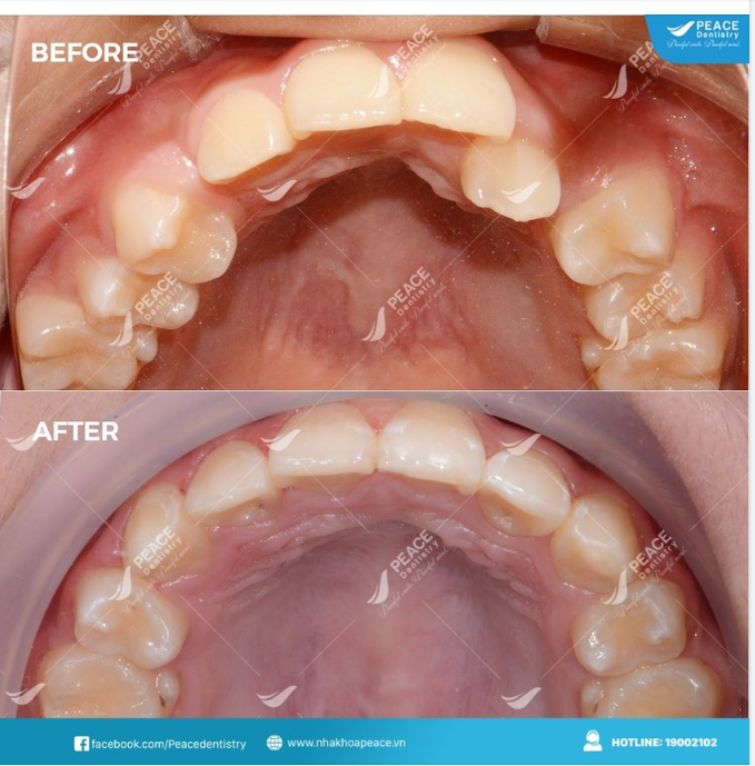 5 LÝ DO BẠN NÊN LỰA CHỌN NIỀNG RĂNG TẠI NHA KHOA PEACE DENTISTRY