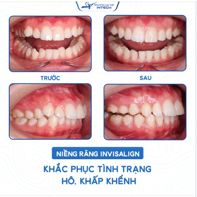 6 THÁNG RĂNG DÀN ĐỀU, CẢI THIỆN HÔ NHỜ NIỀNG RĂNG INVISALIGN