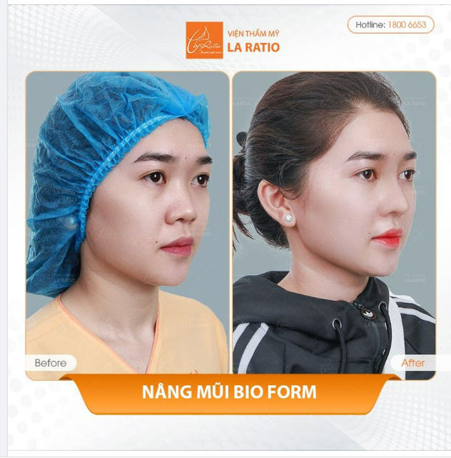 AI NÊN NÂNG MŨI BIOFORM