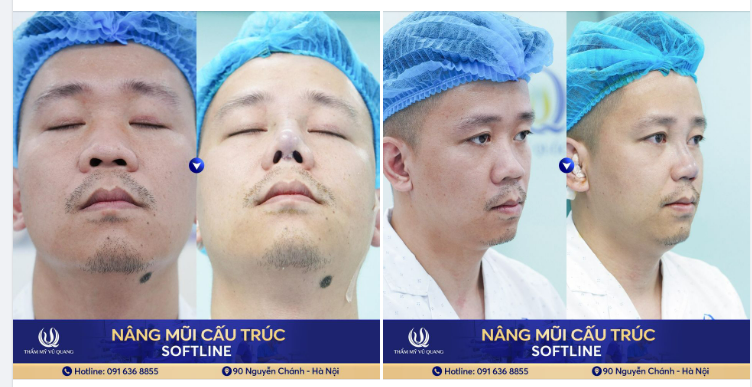 Anh Việt Tiến đi từ Lào Cai đến với Thẩm mỹ Vũ Quang, đặt trọn niềm tin vào Bác sĩ Vũ Quang để khắc phục khuyết điểm của dáng mũi cũ khiến gương mặt già hơn tuổi