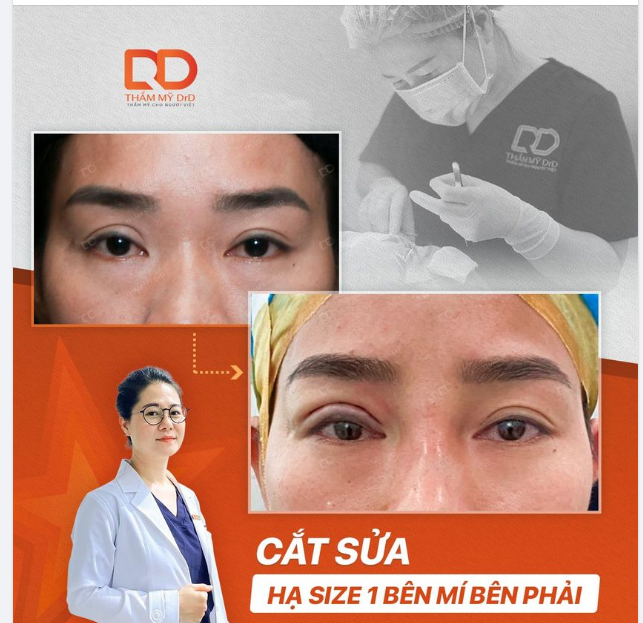 Bác sĩ Hồng Vân chia sẻ về 1 ca SỬA MÍ HẠ SIZE 1 BÊN