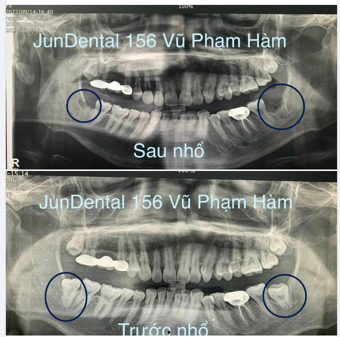 Bác sĩ Jun Dental đã dọn sạch 2 chiếc hư này trong vòng 30 phút cực kì nhẹ nhàng.