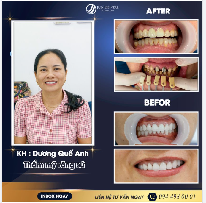 Bất ngờ trước sự thay đổi của khách hàng Dương Quế Anh đến Jun Dental thẩm mỹ răng sứ.