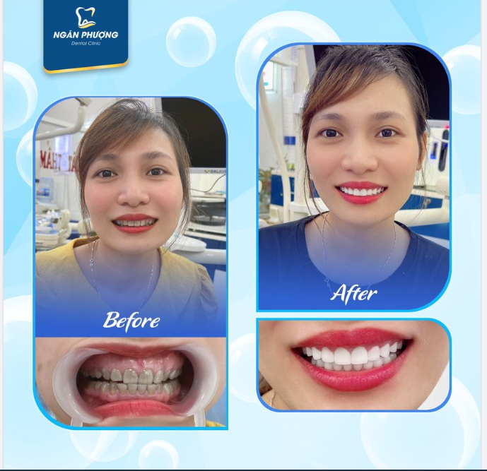 Bật tone trắng sáng, nâng tầm nụ cười