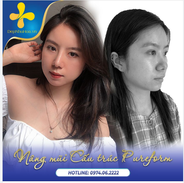 Bí quyết làm nên một khuôn mặt xinh tươi, rạng rỡ của chị em là DÁNG MŨI THANH CAO, THON GỌN TỰ NHIÊN