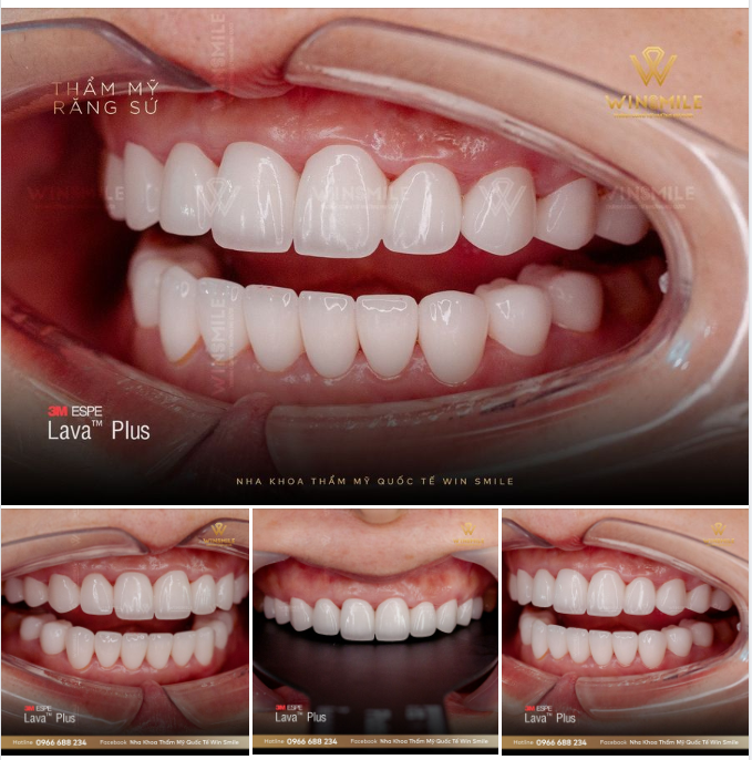 BÍ QUYẾT SỞ HỮU RĂNG SỨ TRONG BÓNG MƯỜI PHÂN VẸN MƯỜI