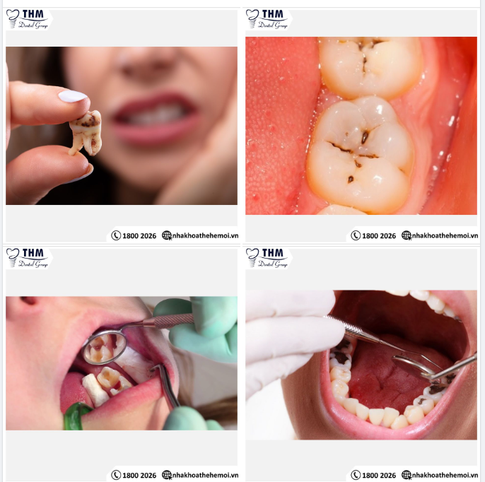 BIẾN CHỨNG CỦA SÂU RĂNG CÓ NGUY HIỂM KHÔNG 