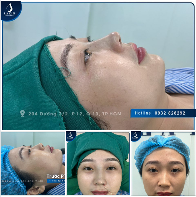 Biết trước kết quả như thế này , thì đã đi nâng mũi sớm hơn