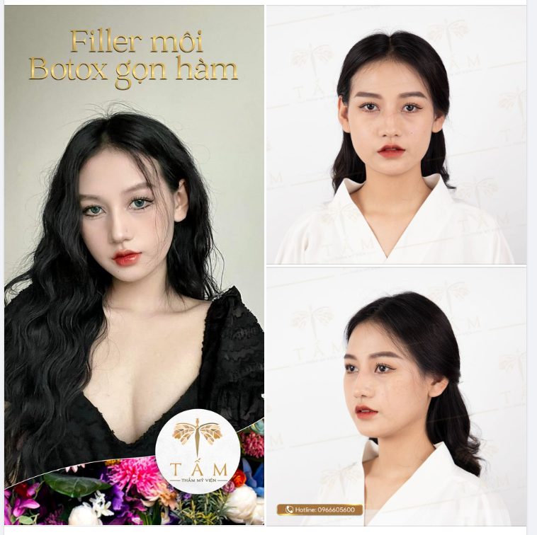 Bộ đôi thẩm mỹ đỉnh cao FILLER MÔI và BOTOX gọn hàm tại Tấm