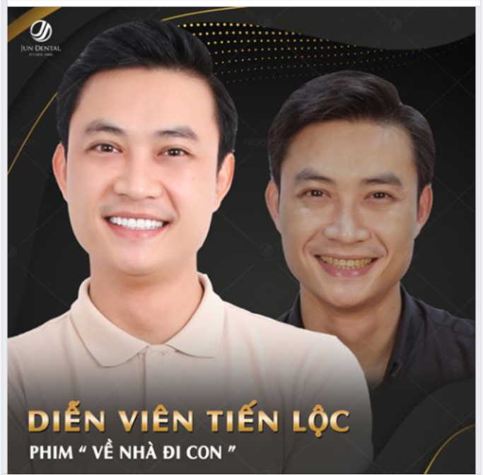 BỌC RĂNG SỨ ĐÃ THAY ĐỔI NỤ CƯỜI CỦA DIỄN VIÊN TIẾN LỘC NHƯ THẾ NÀO?
