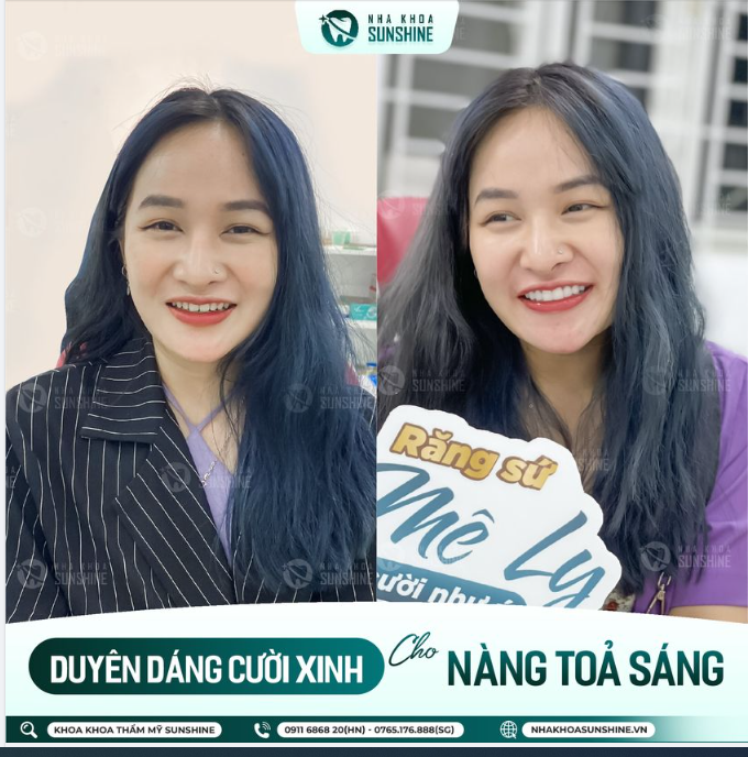 BỌC RĂNG SỨ ĐẸP NHƯNG CHƯA ĐỦ