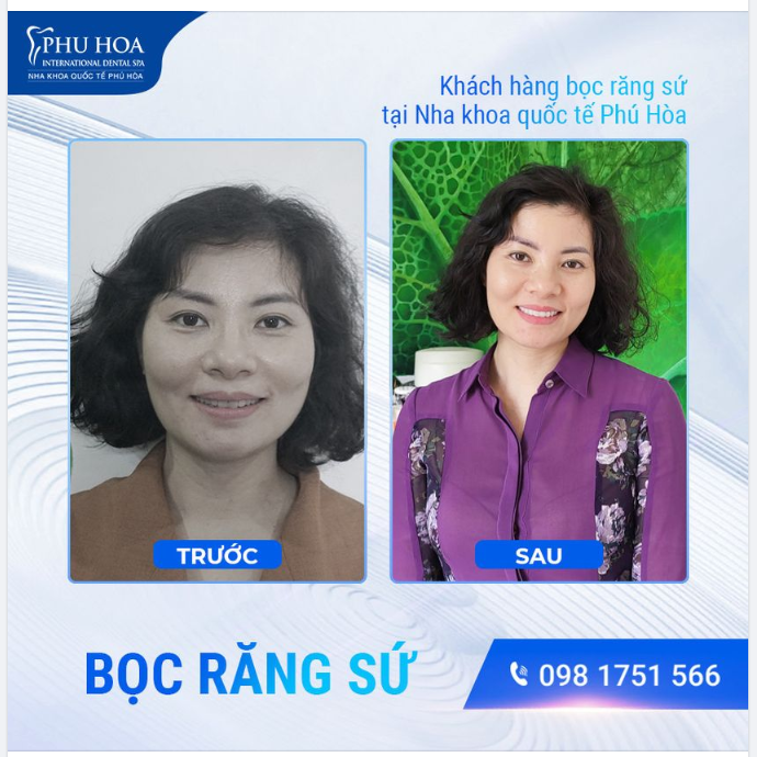 BỌC RĂNG SỨ NHA KHOA QUỐC TẾ PHÚ HÒA
