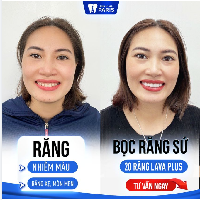 BỌC RĂNG SỨ SÁNG BỪNG NỤ CƯỜI, TỰ TIN TỎA SÁNG