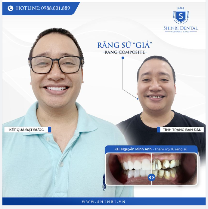 BÓC TRẦN SỰ THẬT VỀ ‘RĂNG SỨ NANO” – GIẢI CỨU NỤ CƯỜI NAM TÍNH CHO KHÁCH HÀNG