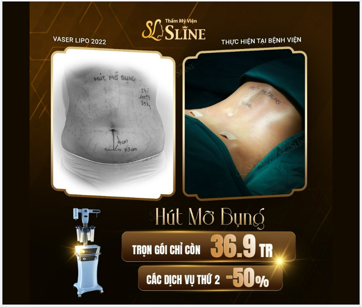 BỤNG MỠ HOÁ BỤNG CƠ TRỌN GÓI 36,9TR