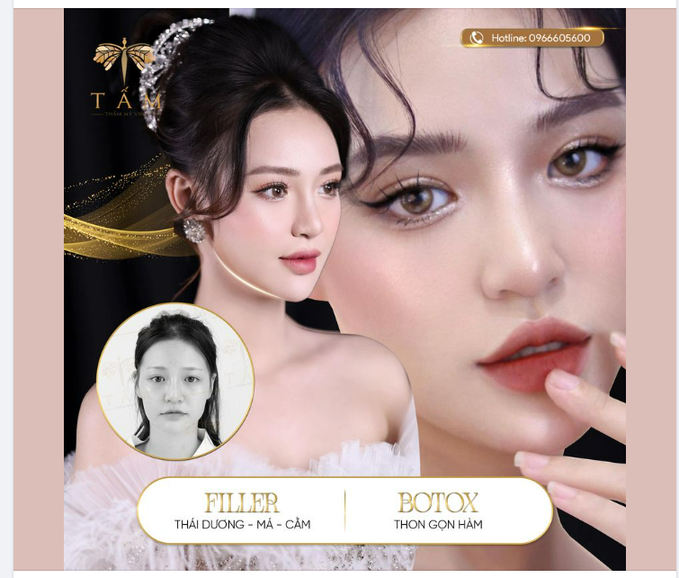 Bừng sáng nhan sắc với Combo Botox gọn hàm + Filler thái dương, má, cằm