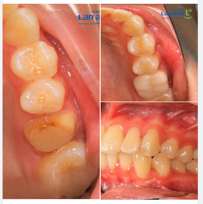 Ca bọc lại răng bị vỡ của bệnh nhân trẻ 14 tuổi của bác sĩ Hiền, chi nhánh Sala, quận 2!