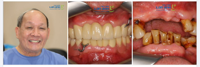 Ca điều trị phục hình toàn hàm cho người lớn tuổi của bác sĩ Đức, chi nhánh Sala, quận 2!