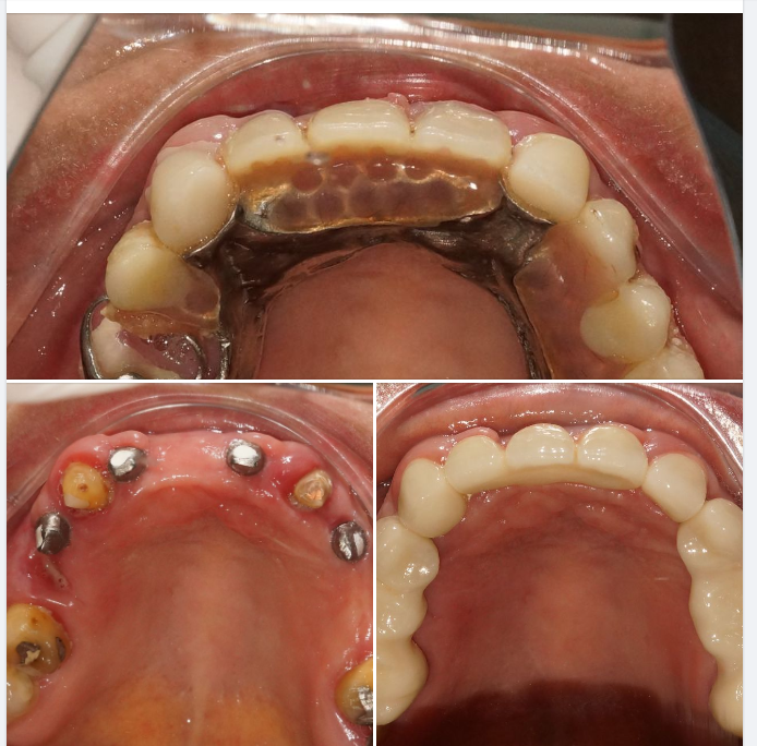 Ca Implant và phục hình răng trên Implant của bác sĩ Tú, chi nhánh Tôn Dật Tiên, quận 7!