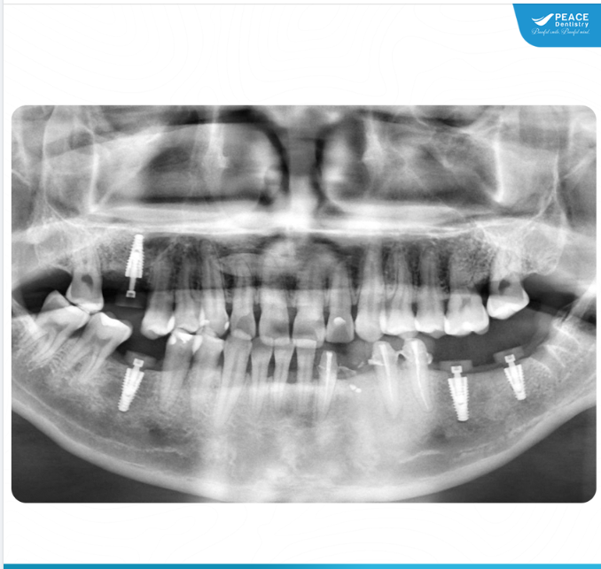 CA LÂM SÀNG CẤY GHÉP 3 IMPLANT
