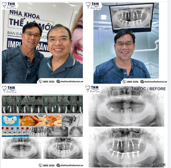 CA LÂM SÀNG CẤY GHÉP IMPLANT CÙNG MÁNG PHẪU THUẬT