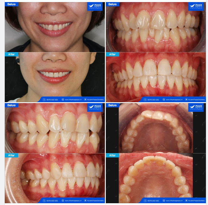 CA LÂM SÀNG CHỈNH NHA VỚI MẮC CÀI TỰ ĐÓNG