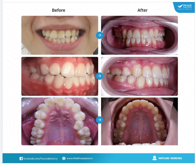 CA LÂM SÀNG NIỀNG RĂNG MẮC CÀI KIM LOẠI TỰ ĐÓNG- THỜI GIAN HOÀN THÀNH 2O THÁNG
