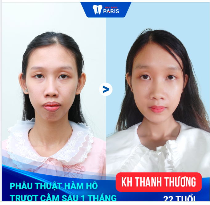 CA PHẪU THUẬT HÀM HÔ THÀNH CÔNG NHẤT 2022 TẠI PARIS