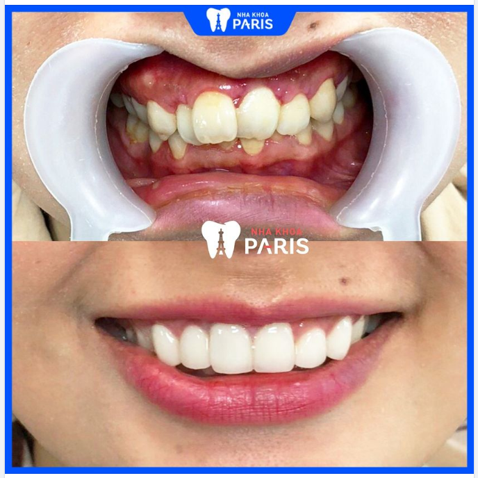 CA RĂNG SỨ KHẤP KHỂNH NẶNG THAY ĐỔI "NGOẠN MỤC" THẦN THÁI