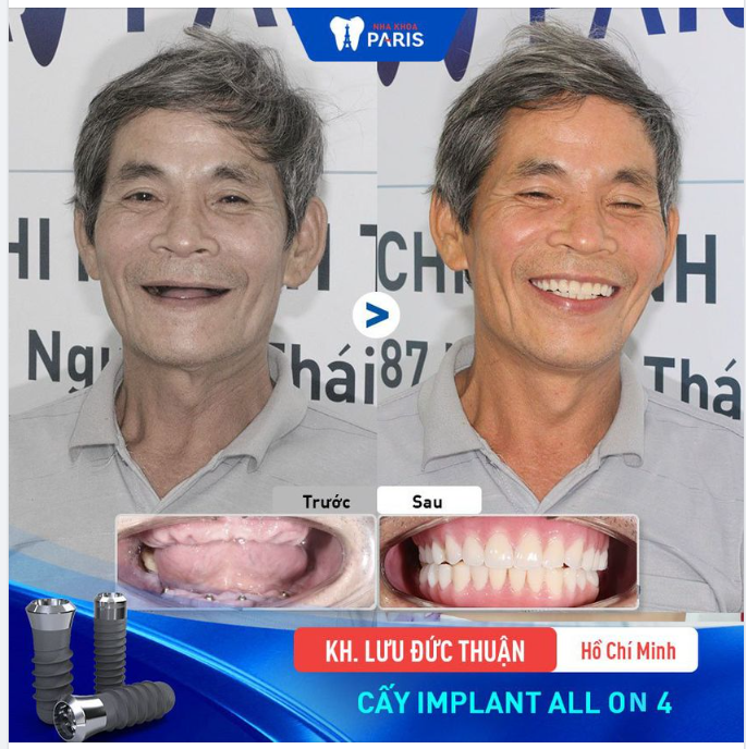 CA TRỒNG RĂNG TOÀN HÀM SIÊU KHÓ CỦA CHÚ LƯU ĐỨC THUẬN