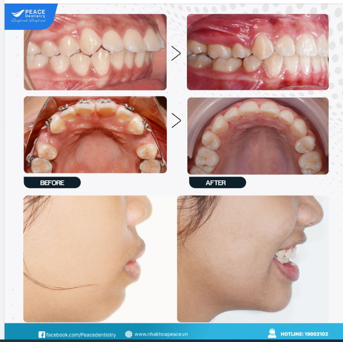CÁC PHƯƠNG PHÁP NIỀNG RĂNG HÔ HIỆU QUẢ