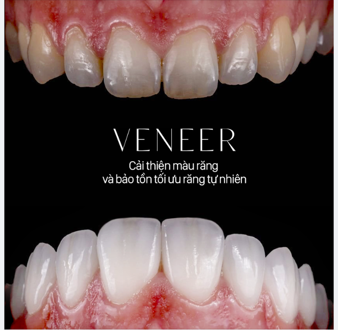 CẢI THIỆN MÀU RĂNG VỚI MẶT DÁN SỨ VENEER VÀ BẢO TỒN MÔ RĂNG TỰ NHIÊN