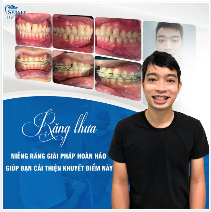 CẢI THIỆN RĂNG THƯA BẰNG PHƯƠNG PHÁP NIỀNG RĂNG