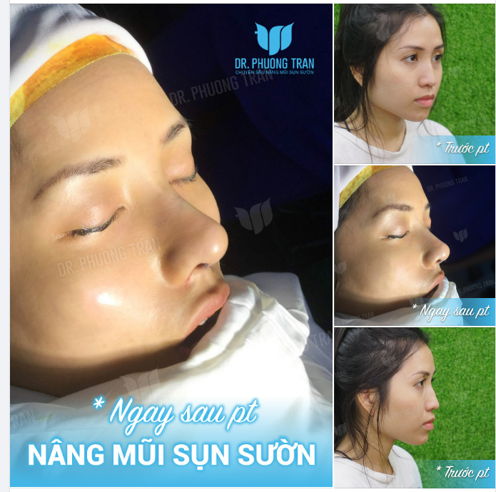 CẦN MỘT LỜI BÌNH CHO CHIẾC MŨI GỒ NẶNG NÀY!
