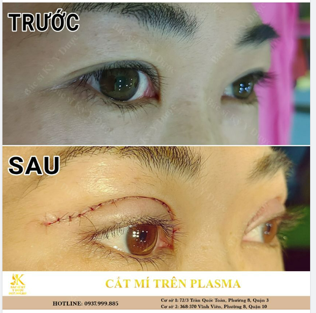 CẮT MẮT MÍ TRÊN PLASMA ​​​​​​​ BS KỲ Y DƯỢC