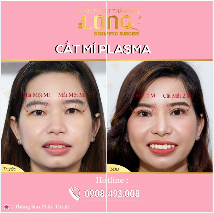 CẮT MÍ - ĐAU - GIẢ TRÂN - KHÔNG TỰ NHIÊN !!! TỐN TIỀN NHƯNG KẾT QUẢ XẤU HƠN LÚC ĐẦU Ư