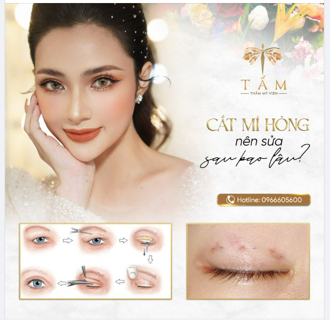 Cắt mí hỏng là điều mà không ai mong muốn, nhưng trong quá trình phẫu thuật vẫn có một số trường hợp bị lỗi, không được như ý muốn. Các trường hợp cắt mí lỗi, hỏng sẽ có hiện tượng trợn, mí lệch, mí không đều, sụp mí.