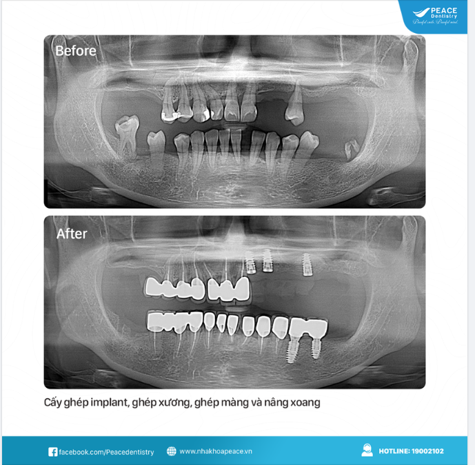 CẤY GHÉP IMPLANT, KHI NÀO CẦN CHỈ ĐỊNH GHÉP XƯƠNG?