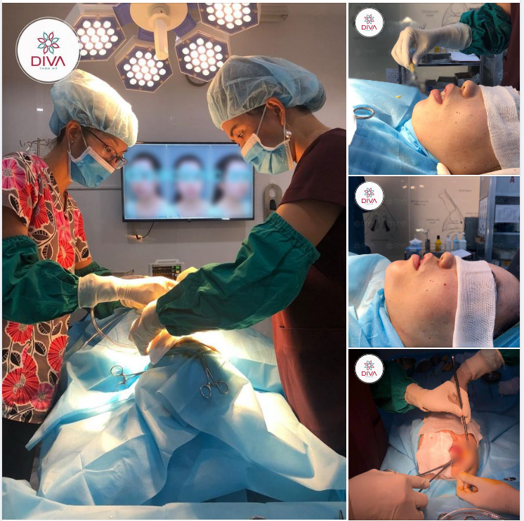 CẤY MỠ COLEMAN MẶT VÀ TÁCH TÚI MỠ MÁ TRONG ĐƯỢC KHÁCH LỰA CHỌN THỰC HIỆN NHIỀU NHẤT TẠI DIVA