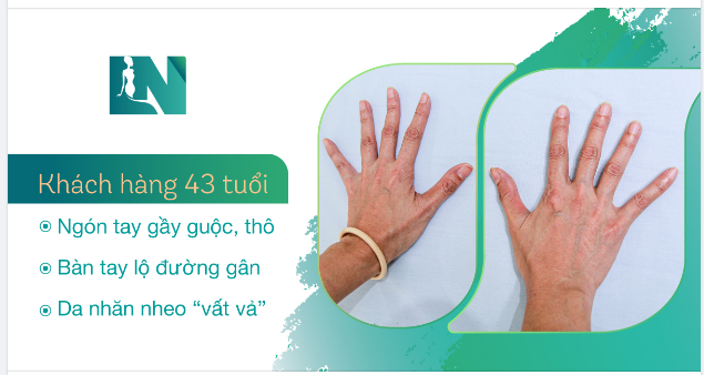 CẤY MỠ TRẺ HÓA BÀN TAY – BÍ QUYẾT SỞ HỮU ĐÔI BÀN TAY THON NUỘT SAU 45 PHÚT