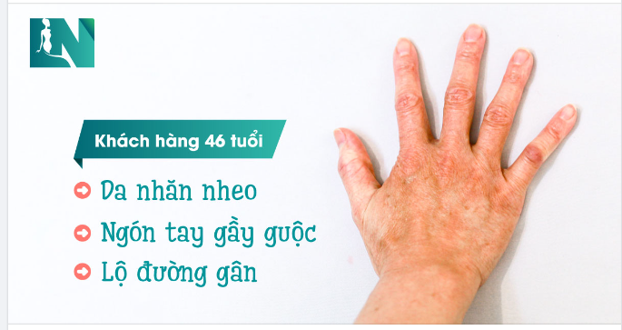  CẤY MỠ TRẺ HÓA BÀN TAY – SỞ HỮU ĐÔI TAY MỀM MẠI LỘC TÀI
