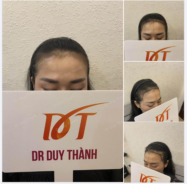 CẤY TÓC NỮ 30 TUỔI TỪ TP.HCM, DỰ KIẾN 1500 NANG