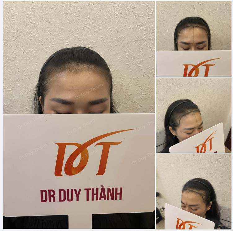 CẤY TÓC NỮ 30 TUỔI TỪ TP.HCM, DỰ KIẾN 1500 NANG