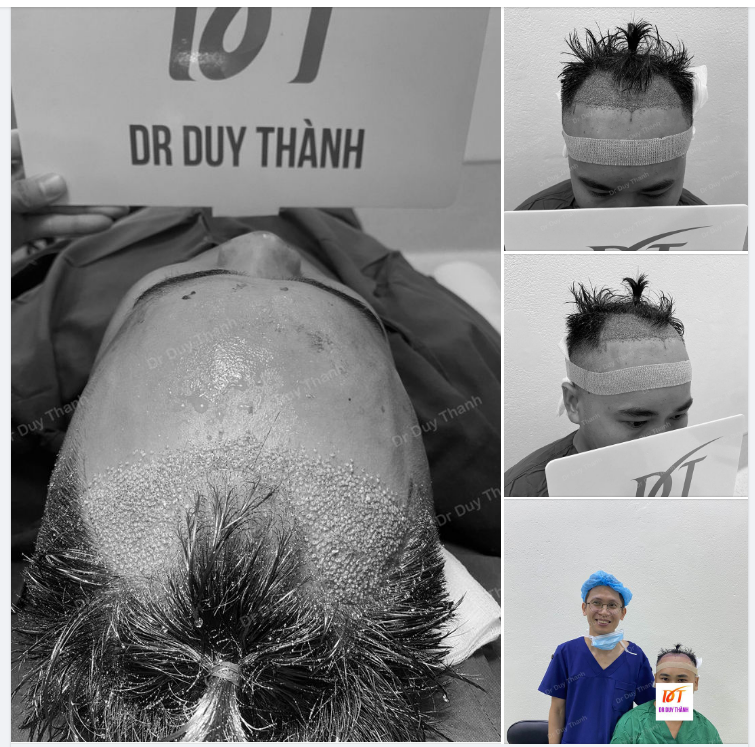 CẤY XONG 1300 NANG TÓC CHO BOY 27 TUỔI NGHỆ AN