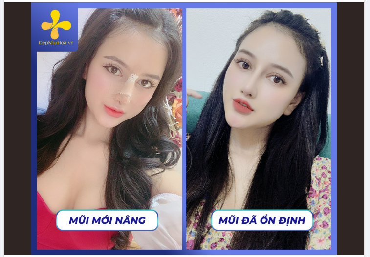 CHĂM SÓC SAU NÂNG MŨI MỘT SỐ ĐIỀU BẠN CẦN LƯU Ý