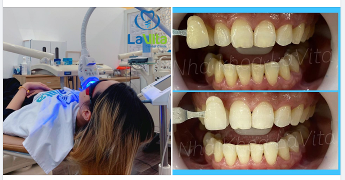Chỉ cần thực hiện 1 lần duy nhất, duy trì hàm răng trắng sáng đến 2-3 năm.