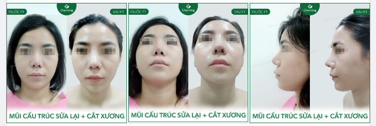 Chỉ cần tìm thấy vấn đề kịp lúc thì mình đều có thể làm lại. Đến Charming cắt xương nền mũi, sửa lại bằng phương pháp nâng mũi cấu trúc là ổn ngay