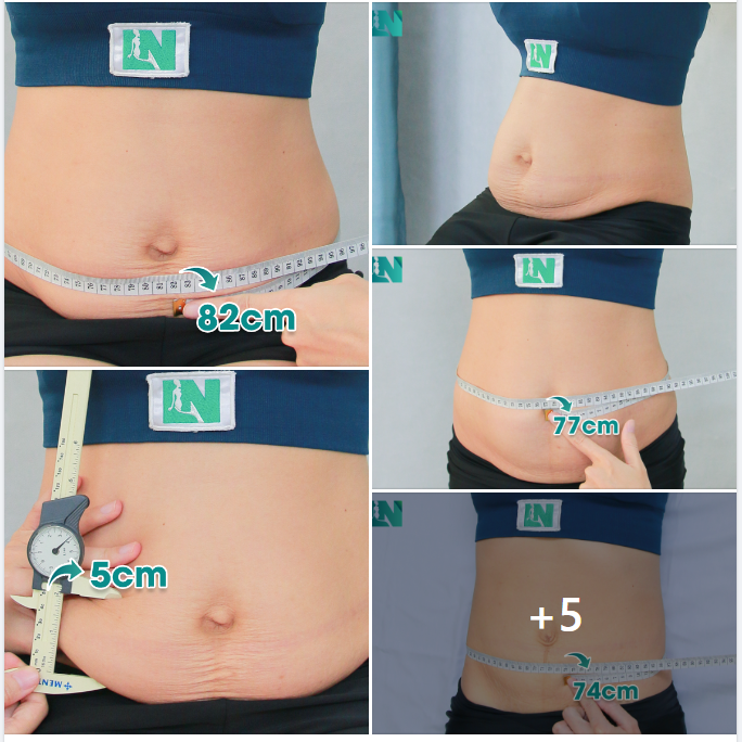 CHỊ KH 34 TUỔI, HIỂU RẰNG MASSAGE TAN MỠ KHÔNG HIỆU QUẢ NÊN ĐÃ CHỌN GIẢM MỠ AN TOÀN. 